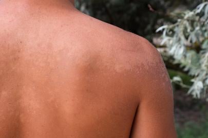 Sunburn on the skin of the back. Exfoliation, skin peels off. Dangerous sun tan.